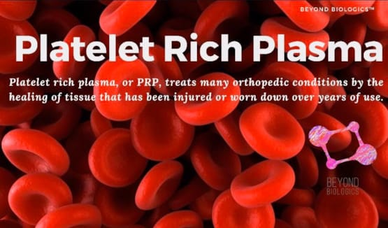 Platelet Rich Plasma (PRP)